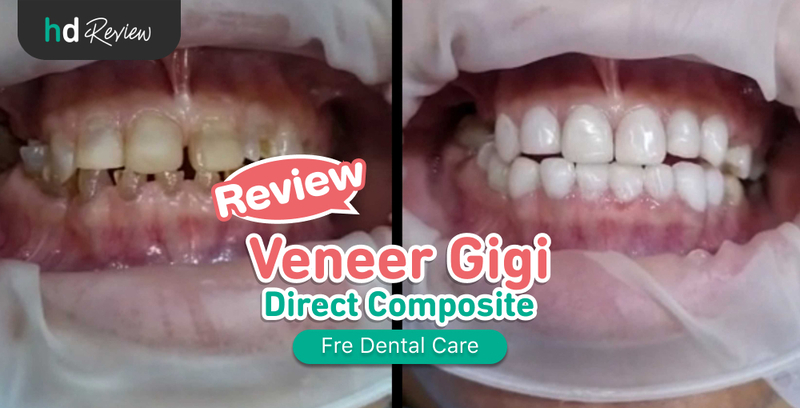 Review Veneer Gigi di Fre Dental