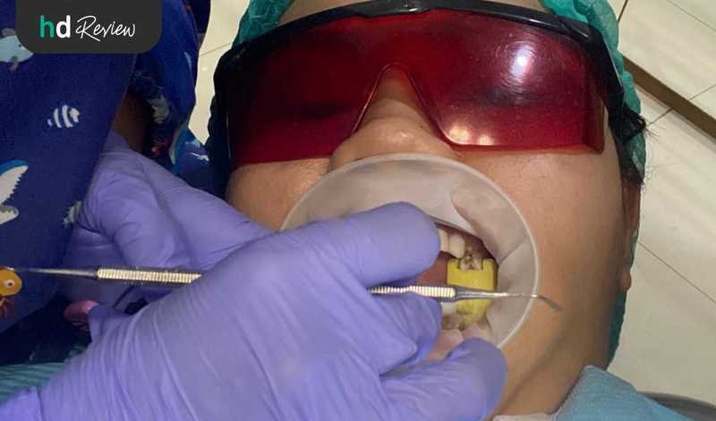 Proses Veneer Gigi di Fre Dental
