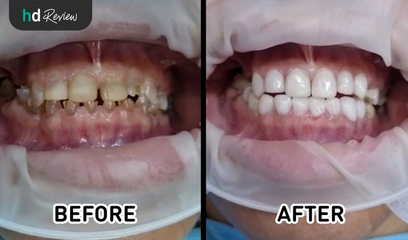 Hasil Veneer Gigi di Fre Dental
