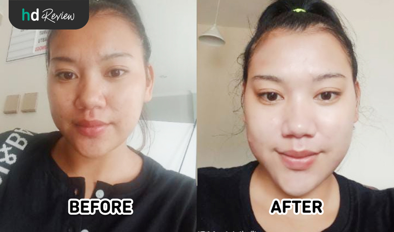 Hasil LED Therapy di Infinite Beauty Clinic