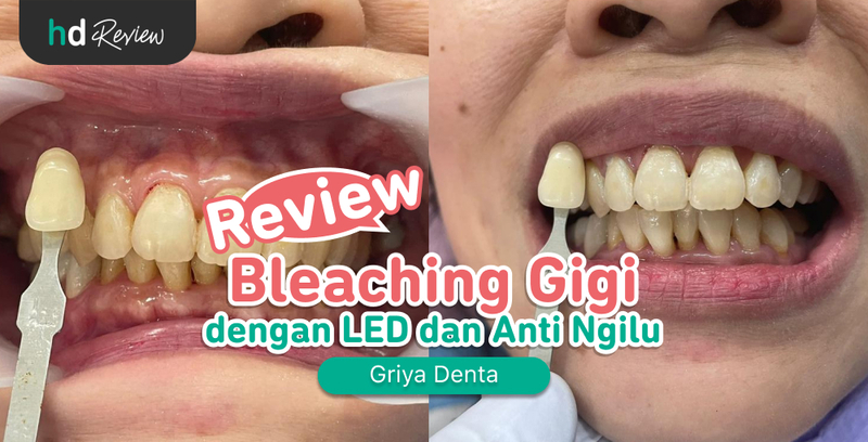 Review Bleaching Gigi di Griya Denta