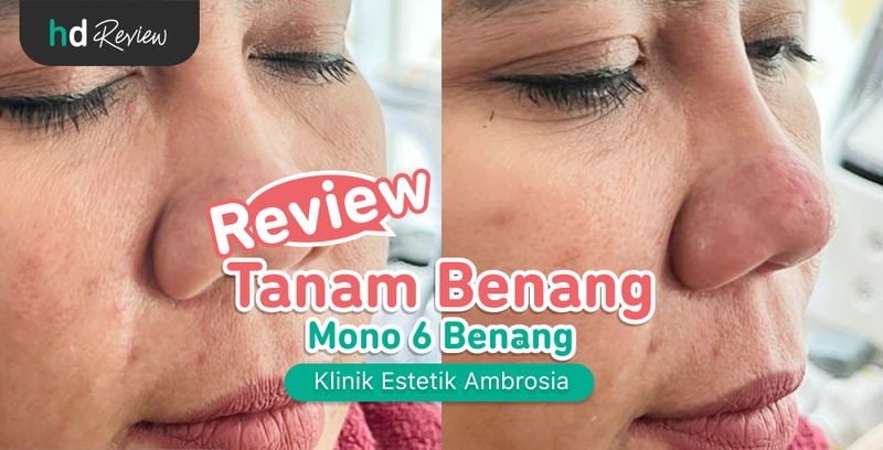 Review Tanam Benang Mono 6 Benang di Klinik Estetik Ambrosia, threadlift, hidung mancung, memancungkan hidung