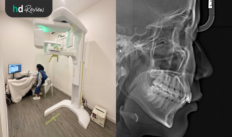Review Rontgen Cephalometri 2D di CS Dental untuk Persiapan Pasang Behel, sefalometri, cephalometry, rontgen gigi