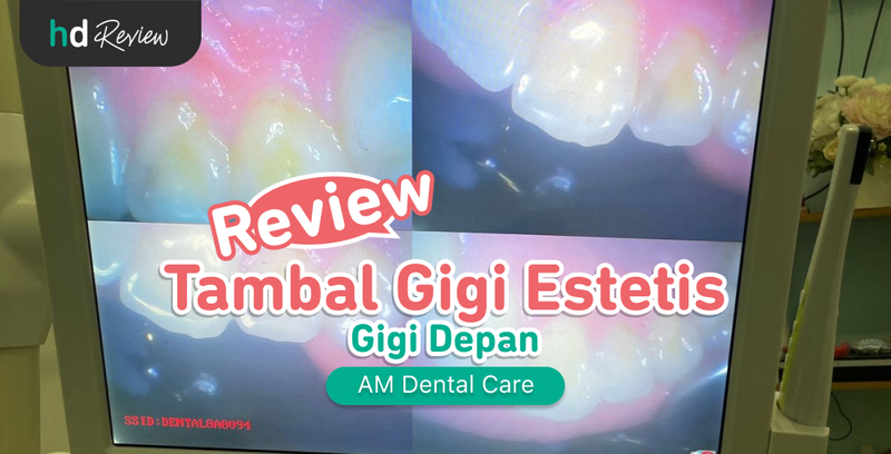 Review Tambal Gigi Estetis di AM Dental Care, Atasi Gigi Depan Berlubang, tambal estetis gigi depan, tambal gigi estetik